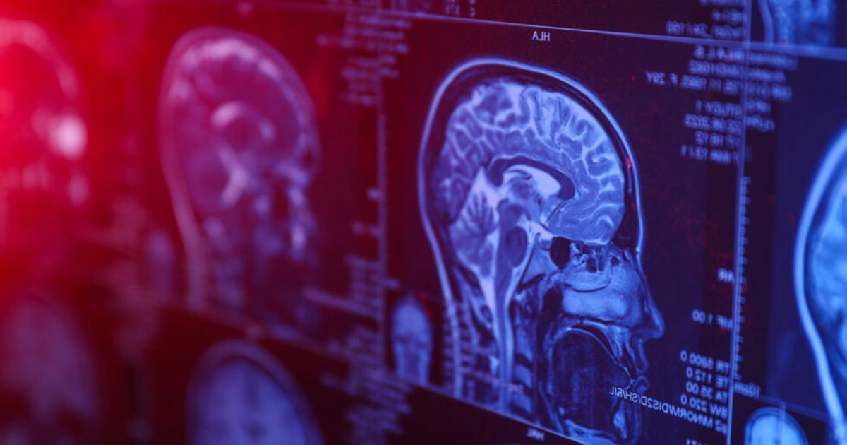 Is TMS a hoax? (The answer is no)